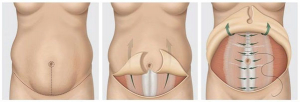 Abdominoplasty 2