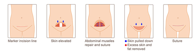 Abdominoplasty 5